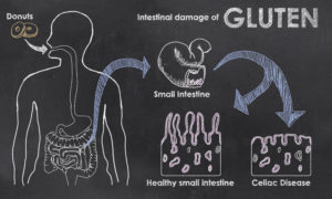 Intestinal Damage of Gluten Celiac versus healthy